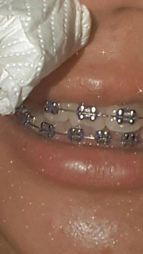 Dental Braces Colors, Braces Colors Combinations, Pink Braces, Silver Braces, Body Jewelry Diy, Teeth Aesthetic, Cute Braces Colors, Braces Tips, Getting Braces