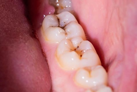 Dental Sealants, Dental Cavities, Dental Plaque, Tooth Sensitivity, How To Prevent Cavities, Alternative Treatments, Dental Hygiene, Tooth Decay, Mouthwash