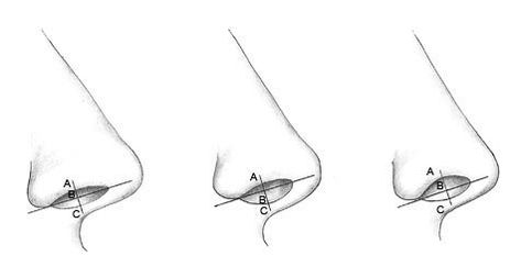 Hanging Columella - Dr Jason Roth | ENT Facial Plastic Surgery Anatomy For Drawing, Rhinoplasty Surgery, Facial Plastic Surgery, Facial Plastic, Profile View, Plastic Surgery, Surgery, Anatomy, Facial