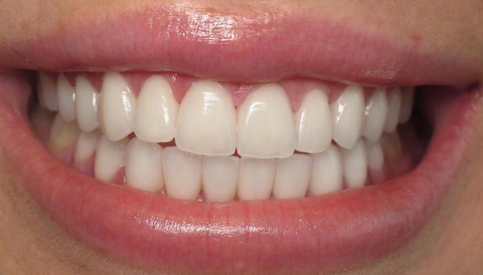 Crush Signs, Teeth Aesthetic, Pretty Teeth, Beautiful Teeth, Porcelain Veneers, Perfect Teeth, Wish Board, Smile Teeth, Manifesting Vision Board