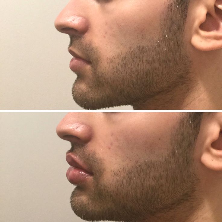 Men Lip Fillers, Mens Lip Filler, Male Lips, We Go Jim, Lip Ideas, Lip Flip, Rhinoplasty Nose Jobs, Lips Inspiration, Botox Lips