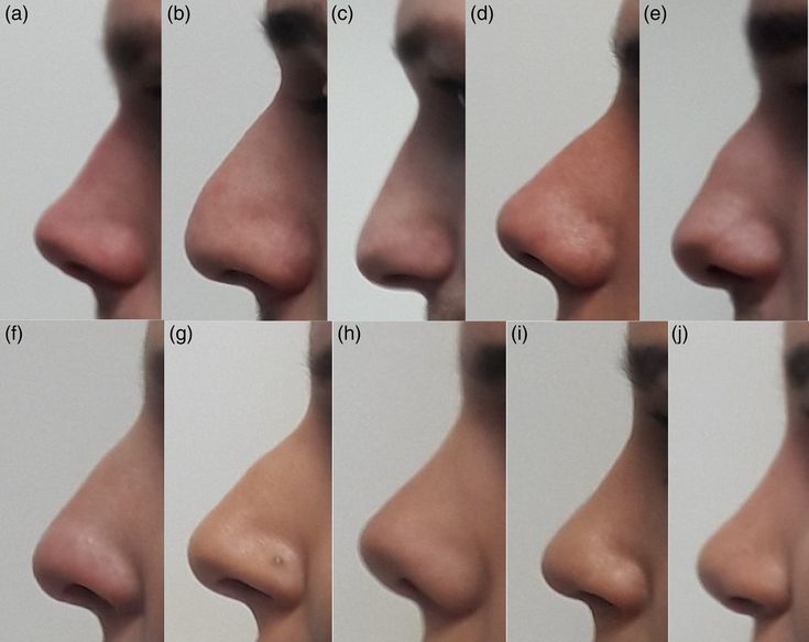 multiple images of different angles of the nose to show how it looks like before and after