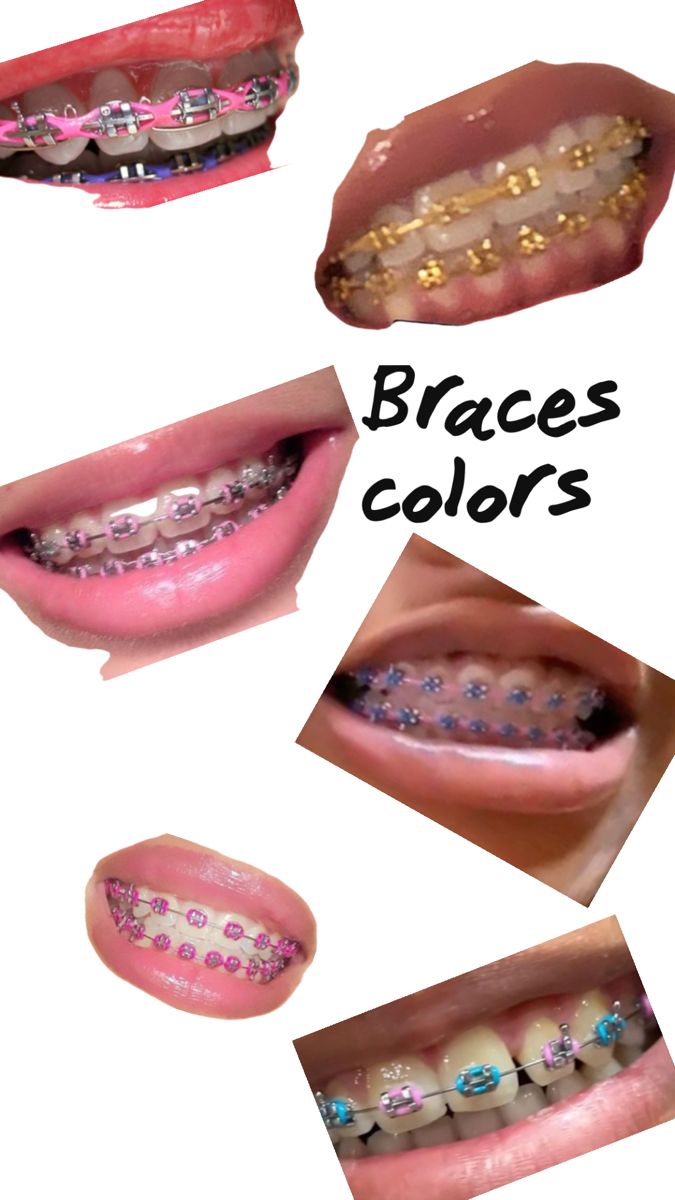 Color Braces Ideas, Good Braces Colors, Braces Colour Ideas, Tips For Braces, Brace Ideas, Braces Colors Combinations, Types Of Teeth, Braces Journey, Pink Braces