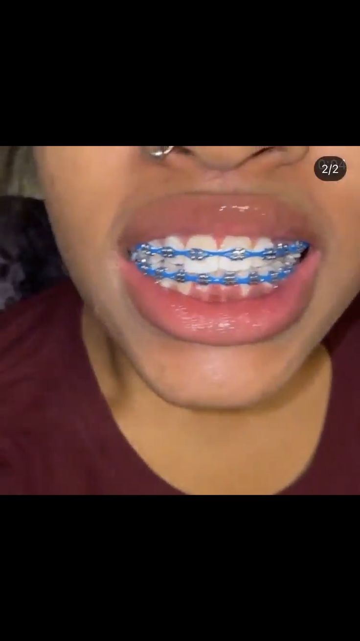 Braces Power Chain Aesthetic, Dark Blue Power Chain Braces, Royal Blue Power Chain Braces, Braces Top Teeth Only, Braces Aesthetic Power Chain, Braces Royal Blue, Braces Without Power Chain, Bright Blue Braces, Braces With Power Chains