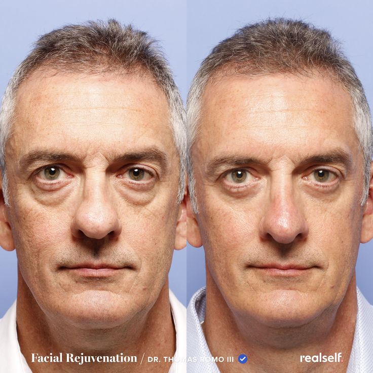 Most people interested in upper eyelid surgery are over 40, the age when you typically see changes as the eye skin loses elasticity and begins to droop. Eye Lid Surgery Before And After, Bigger Eyes Surgery, Eye Enlargement Surgery, Male Plastic Surgery Before After, Fox Eye Lift Surgery, Remove Eye Bags, Surgery Doctor, Droopy Eyelids, Beauty Procedures