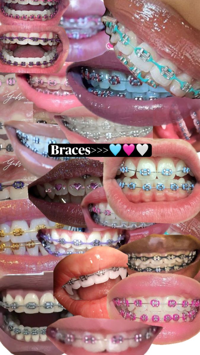 It’s your sign 🩵 Perfect Teeth Braces, Braces Colours, Teeth Aesthetic, Cute Braces Colors, Pretty Teeth, Braces Tips, Getting Braces, Cute Braces, 16th Birthday Decorations