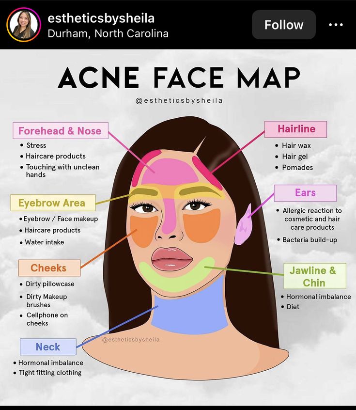 Acne Face Map, Face Map, Face Mapping Acne, Haut Routine, Face Mapping, Skin Advice, Acne Face, Skin Care Routine Order, Basic Skin Care Routine