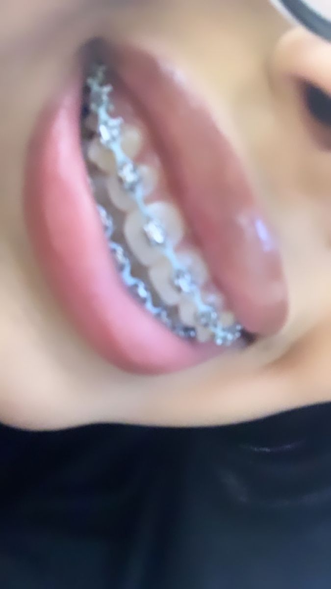 Light Blue Braces, Power Chain Braces, Dental Braces Colors, Pink Braces, Cute Braces Colors, Pretty Teeth, Braces Tips, Getting Braces, Cute Braces