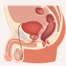 Testicular Cancer