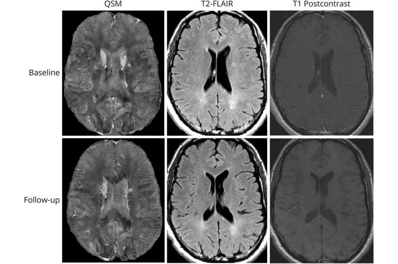 Two UB studies on MS patients reveal how paramagnetic rim lesions evolve and what they mean for disease progression