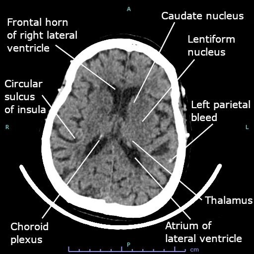 File:CT scan of left small parietal bleed of brain.jpg