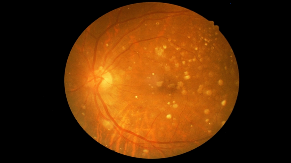 Visualization of macular degeneration showing the progressive damage to the retina's central region, known as the macula, leading to impaired central vision.