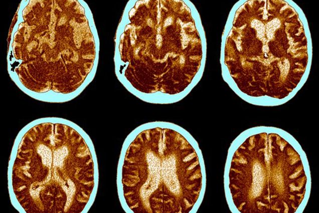 Photo: A CT scan of a brain with Alzheimer's disease