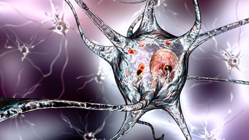 ​About Parkinson's Disease | NHGRI